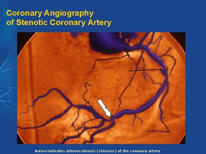 Coronary Angiography of Stenotic Coronary Artery 6 Arrow indicates atherosclerosis (stenosis) of the coronary Coronary Angiography of Stenotic Coronary Artery 6 Arrow indicates atherosclerosis (stenosis) of the coronary