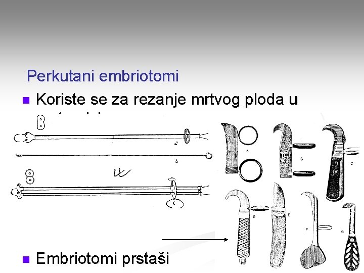 Perkutani embriotomi n Koriste se za rezanje mrtvog ploda u maternici n Embriotomi prstaši