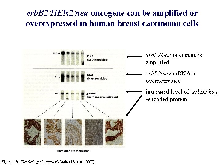 erb. B 2/HER 2/neu oncogene can be amplified or overexpressed in human breast carcinoma