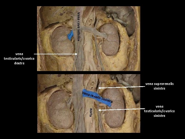 Vena cava inferior vena testicularis/ovarica dextra Vena vena suprarenalis sinistra rena lis si nistr