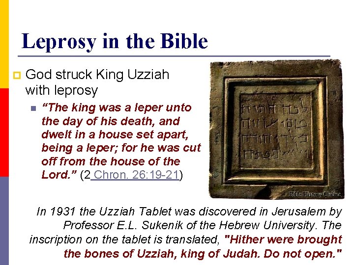 Leprosy in the Bible p God struck King Uzziah with leprosy n “The king