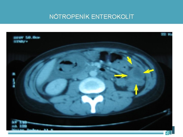 NÖTROPENİK ENTEROKOLİT 