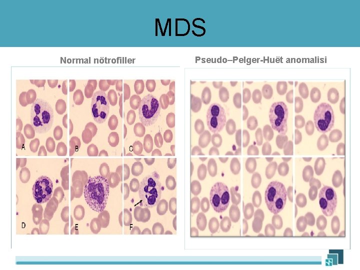 MDS Normal nötrofiller Pseudo–Pelger-Huët anomalisi 