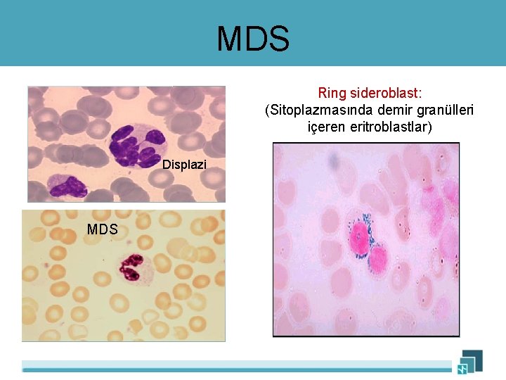 MDS Ring sideroblast: (Sitoplazmasında demir granülleri içeren eritroblastlar) Displazi MDS 