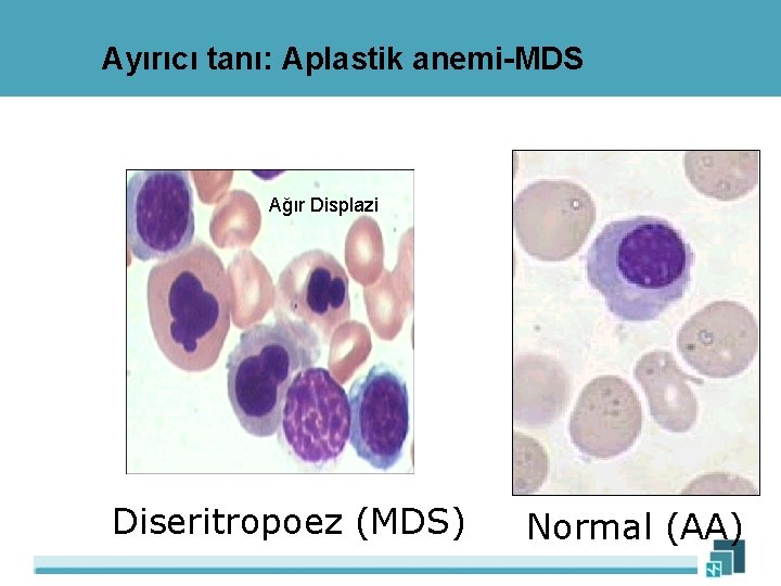 Ayırıcı tanı: Aplastik anemi-MDS Ağır Displazi Diseritropoez (MDS) Normal (AA) 