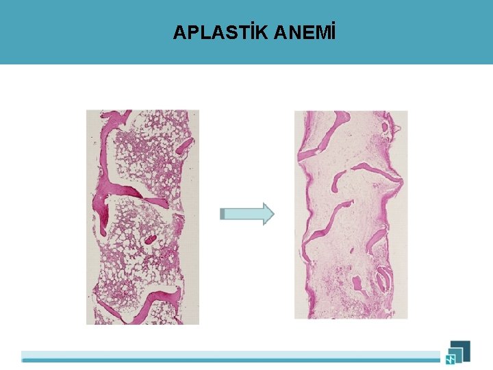 APLASTİK ANEMİ 