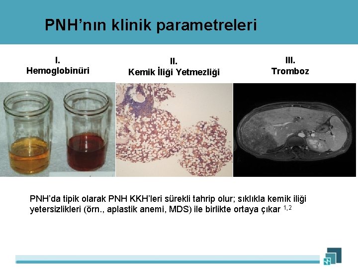 PNH’nın klinik parametreleri I. Hemoglobinüri II. Kemik İliği Yetmezliği III. Tromboz PNH’da tipik olarak