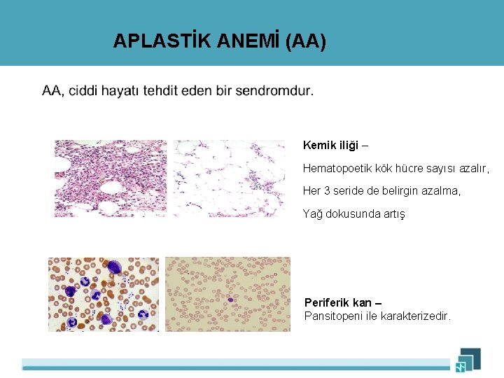 APLASTİK ANEMİ (AA) Kemik iliği – Hematopoetik kök hücre sayısı azalır, Her 3 seride