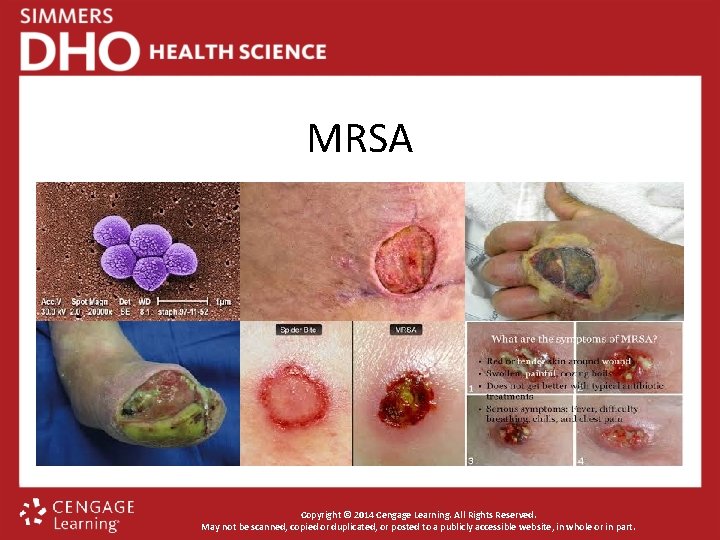 MRSA Copyright © 2014 Cengage Learning. All Rights Reserved. May not be scanned, copied