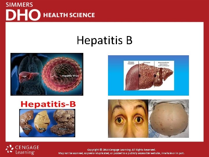Hepatitis B Copyright © 2014 Cengage Learning. All Rights Reserved. May not be scanned,