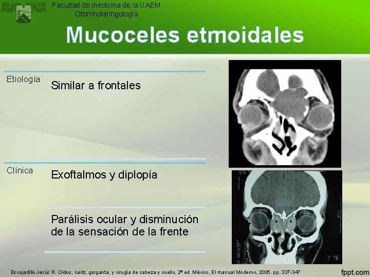 Facultad de medicina de la UAEM Otorrinolaringología Mucoceles etmoidales Etiología Clínica Similar a frontales