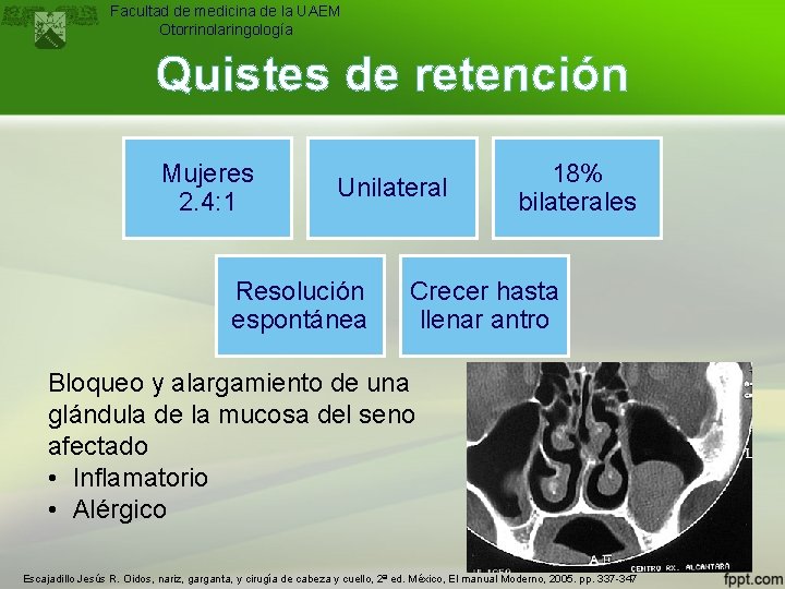 Facultad de medicina de la UAEM Otorrinolaringología Quistes de retención Mujeres 2. 4: 1