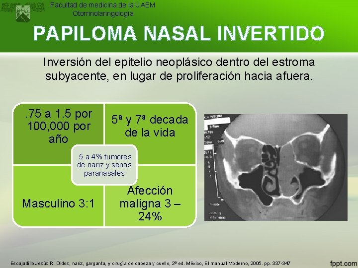 Facultad de medicina de la UAEM Otorrinolaringología PAPILOMA NASAL INVERTIDO Inversión del epitelio neoplásico