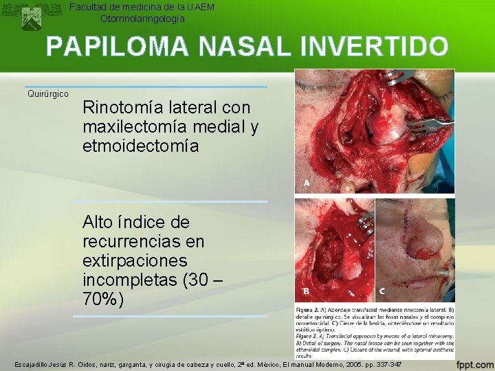 Facultad de medicina de la UAEM Otorrinolaringología PAPILOMA NASAL INVERTIDO Quirúrgico Rinotomía lateral con