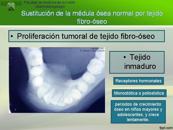 Facultad de medicina de la UAEM Otorrinolaringología Sustitución de la médula ósea normal por