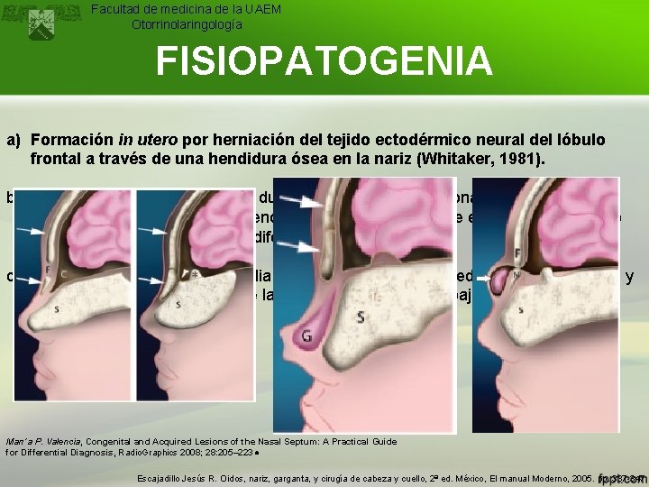 Facultad de medicina de la UAEM Otorrinolaringología FISIOPATOGENIA a) Formación in utero por herniación