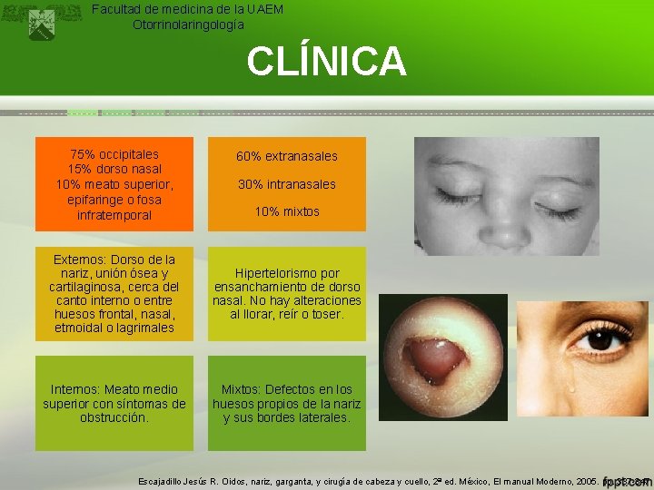 Facultad de medicina de la UAEM Otorrinolaringología CLÍNICA 75% occipitales 15% dorso nasal 10%