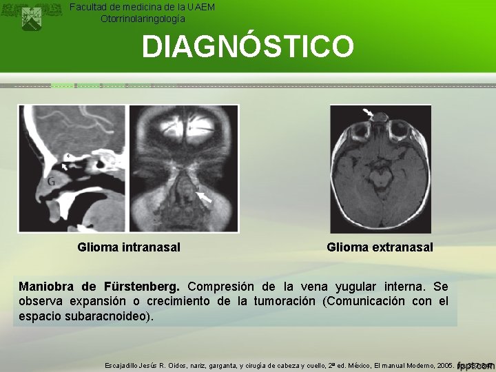 Facultad de medicina de la UAEM Otorrinolaringología DIAGNÓSTICO Glioma intranasal Glioma extranasal Maniobra de