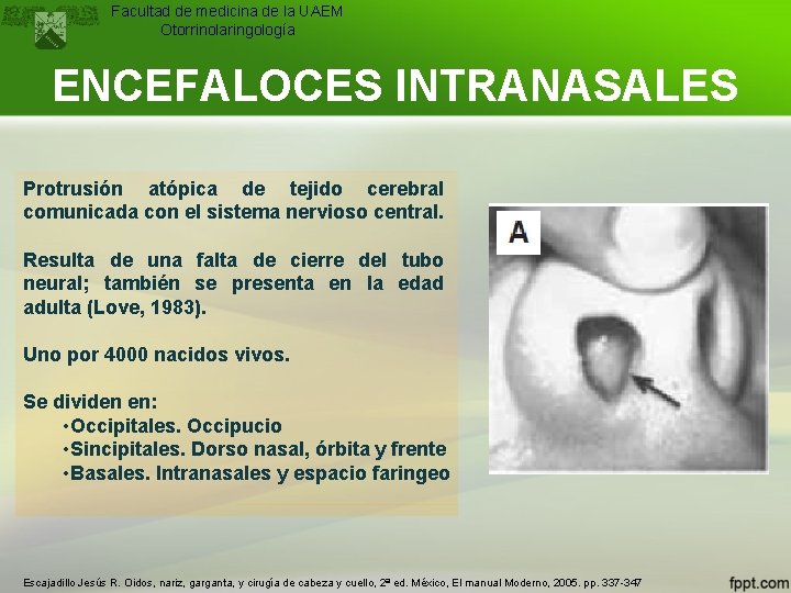 Facultad de medicina de la UAEM Otorrinolaringología ENCEFALOCES INTRANASALES Protrusión atópica de tejido cerebral