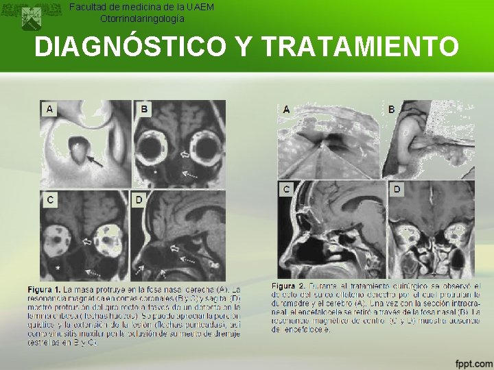 Facultad de medicina de la UAEM Otorrinolaringología DIAGNÓSTICO Y TRATAMIENTO 