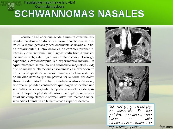 Facultad de medicina de la UAEM Otorrinolaringología SCHWANNOMAS NASALES RM axial (A) y coronal