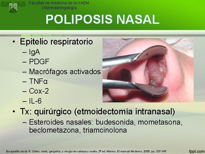 Facultad de medicina de la UAEM Otorrinolaringología POLIPOSIS NASAL • Epitelio respiratorio – Ig.