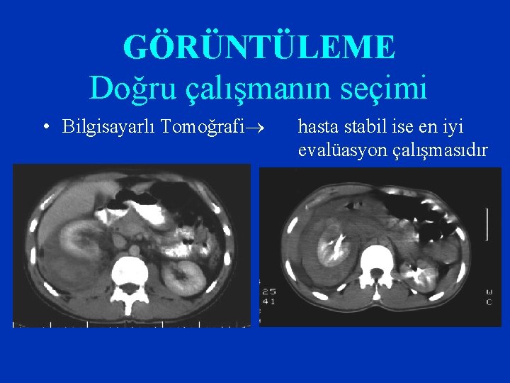 GÖRÜNTÜLEME Doğru çalışmanın seçimi • Bilgisayarlı Tomoğrafi hasta stabil ise en iyi evalüasyon çalışmasıdır