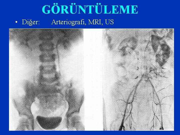 GÖRÜNTÜLEME • Diğer: Arteriografi, MRI, US 