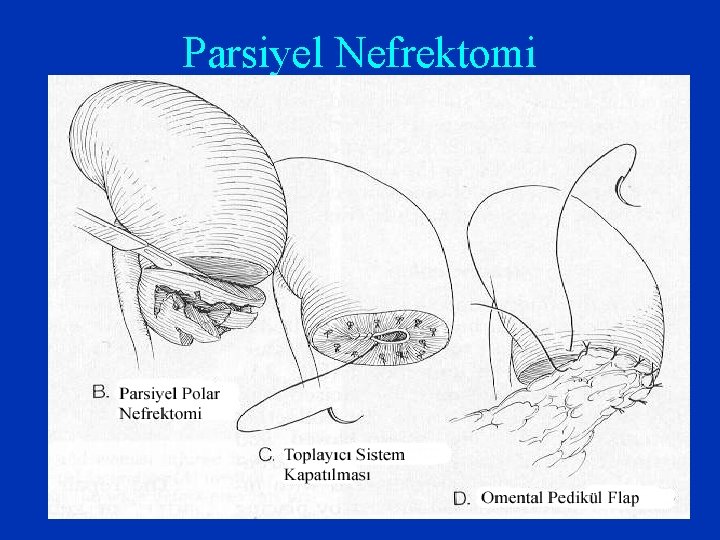 Parsiyel Nefrektomi Parsiyel Nefrektomi
