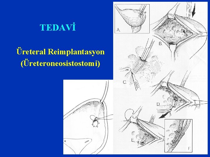 TEDAVİ Üreteral Reimplantasyon (Üreteroneosistostomi) 