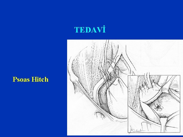 TEDAVİ Psoas Hitch TEDAVİ Psoas Hitch