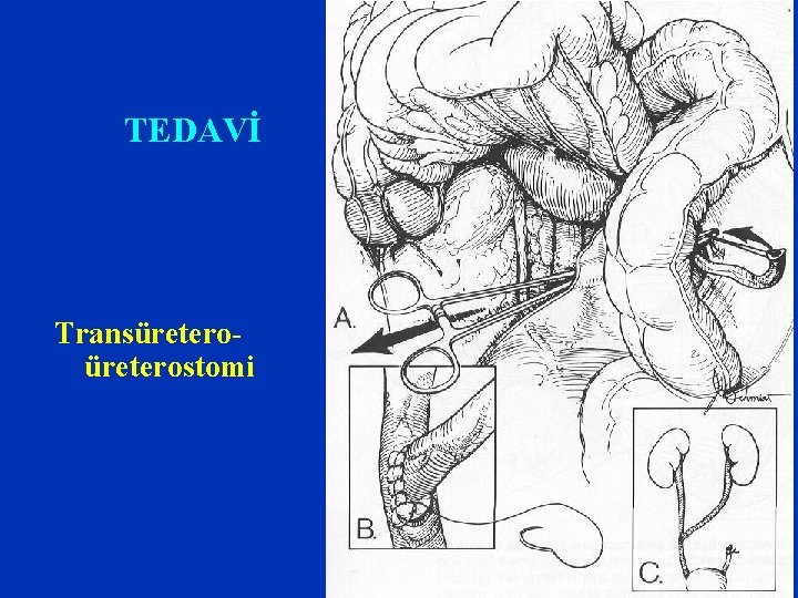 TEDAVİ Transüreterostomi 