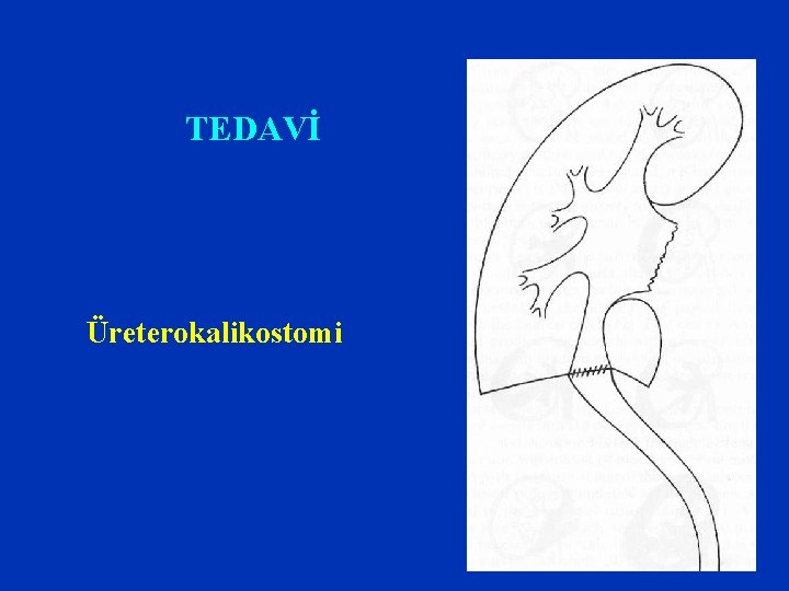 TEDAVİ Üreterokalikostomi TEDAVİ Üreterokalikostomi