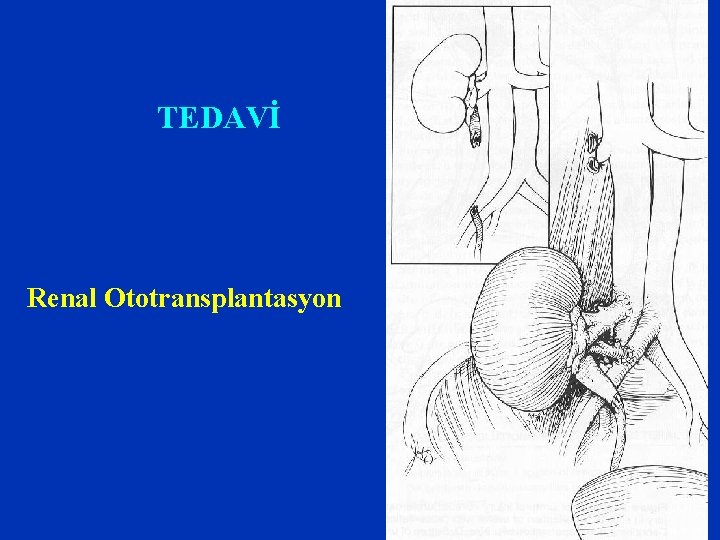 TEDAVİ Renal Ototransplantasyon 