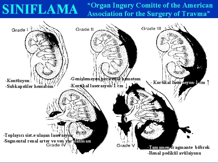 SINIFLAMA -Kontüzyon -Subkapsüler hematom “Organ Ingury Comitte of the American Association for the Surgery