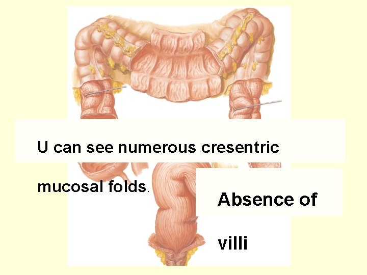 U can see numerous cresentric mucosal folds. Absence of villi 