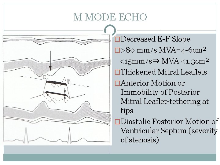 M MODE ECHO �Decreased E-F Slope �>80 mm/s MVA=4 -6 cm² <15 mm/s⇒ MVA
