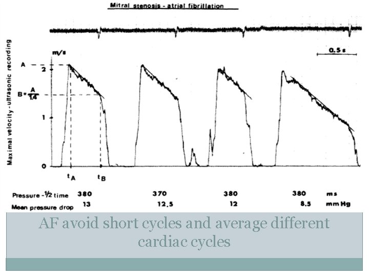 AF avoid short cycles and average different cardiac cycles 