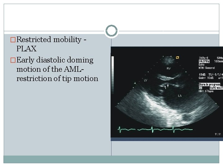 �Restricted mobility - PLAX �Early diastolic doming motion of the AMLrestriction of tip motion
