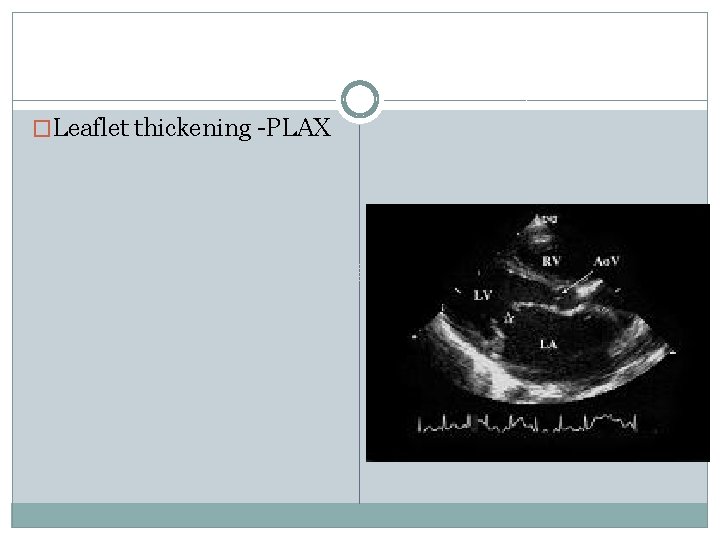 �Leaflet thickening -PLAX 