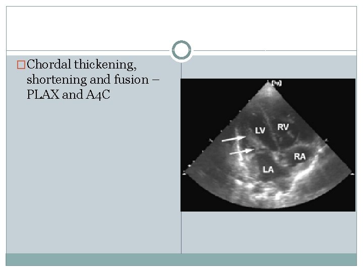 �Chordal thickening, shortening and fusion – PLAX and A 4 C 