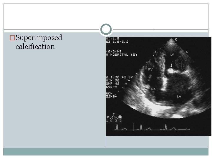 �Superimposed calcification 