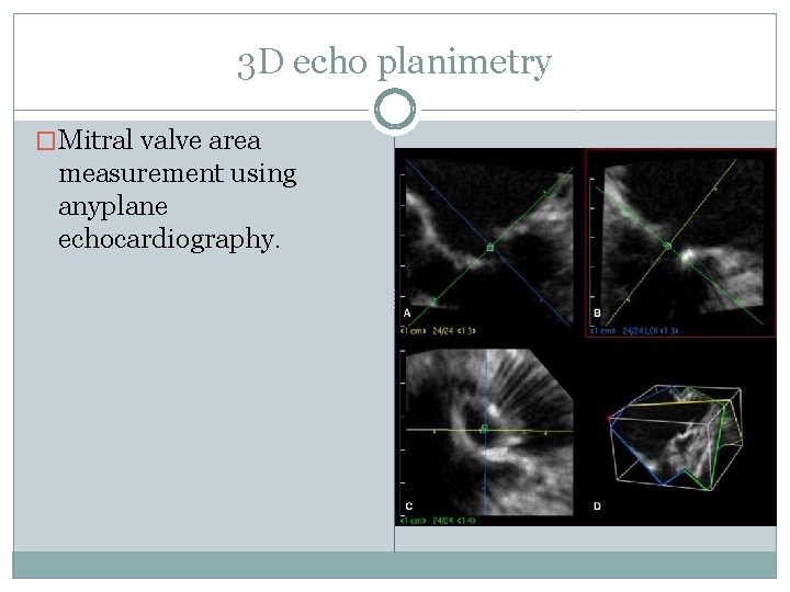 3 D echo planimetry �Mitral valve area measurement using anyplane echocardiography. 