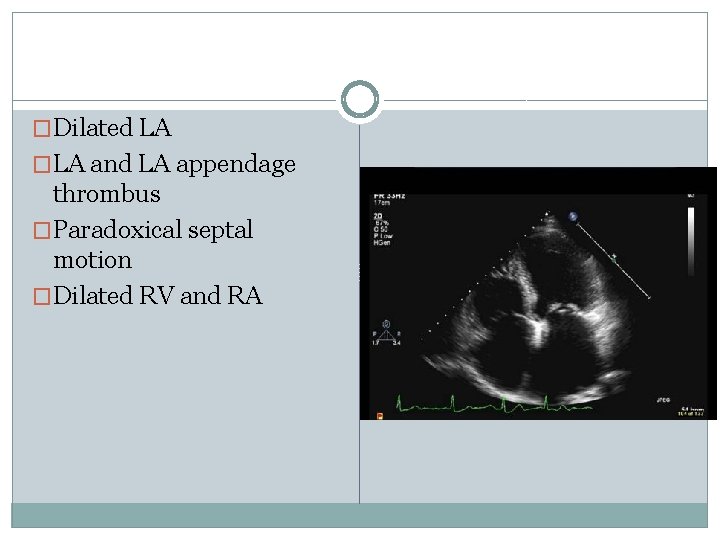 �Dilated LA �LA and LA appendage thrombus �Paradoxical septal motion �Dilated RV and RA