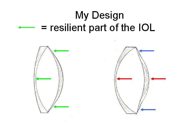 My Design = resilient part of the IOL 