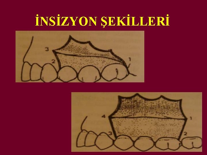 İNSİZYON ŞEKİLLERİ 