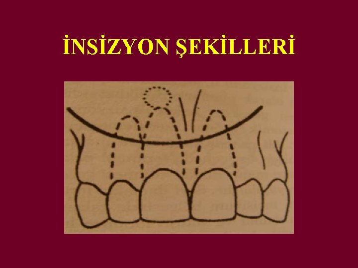İNSİZYON ŞEKİLLERİ 