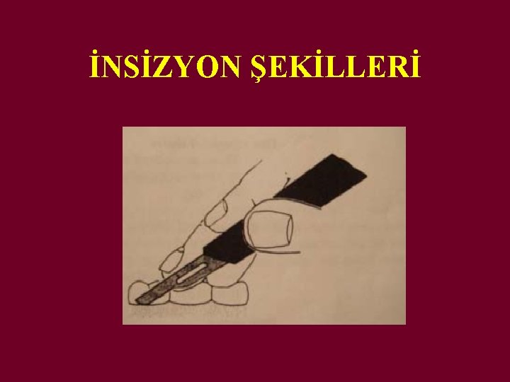 İNSİZYON ŞEKİLLERİ 
