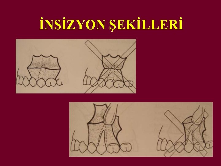 İNSİZYON ŞEKİLLERİ 
