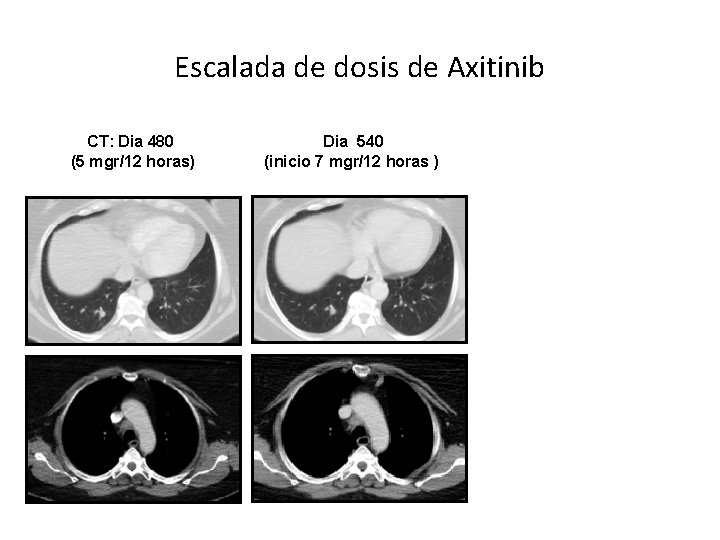 Escalada de dosis de Axitinib CT: Dia 480 (5 mgr/12 horas) Dia 540 (inicio